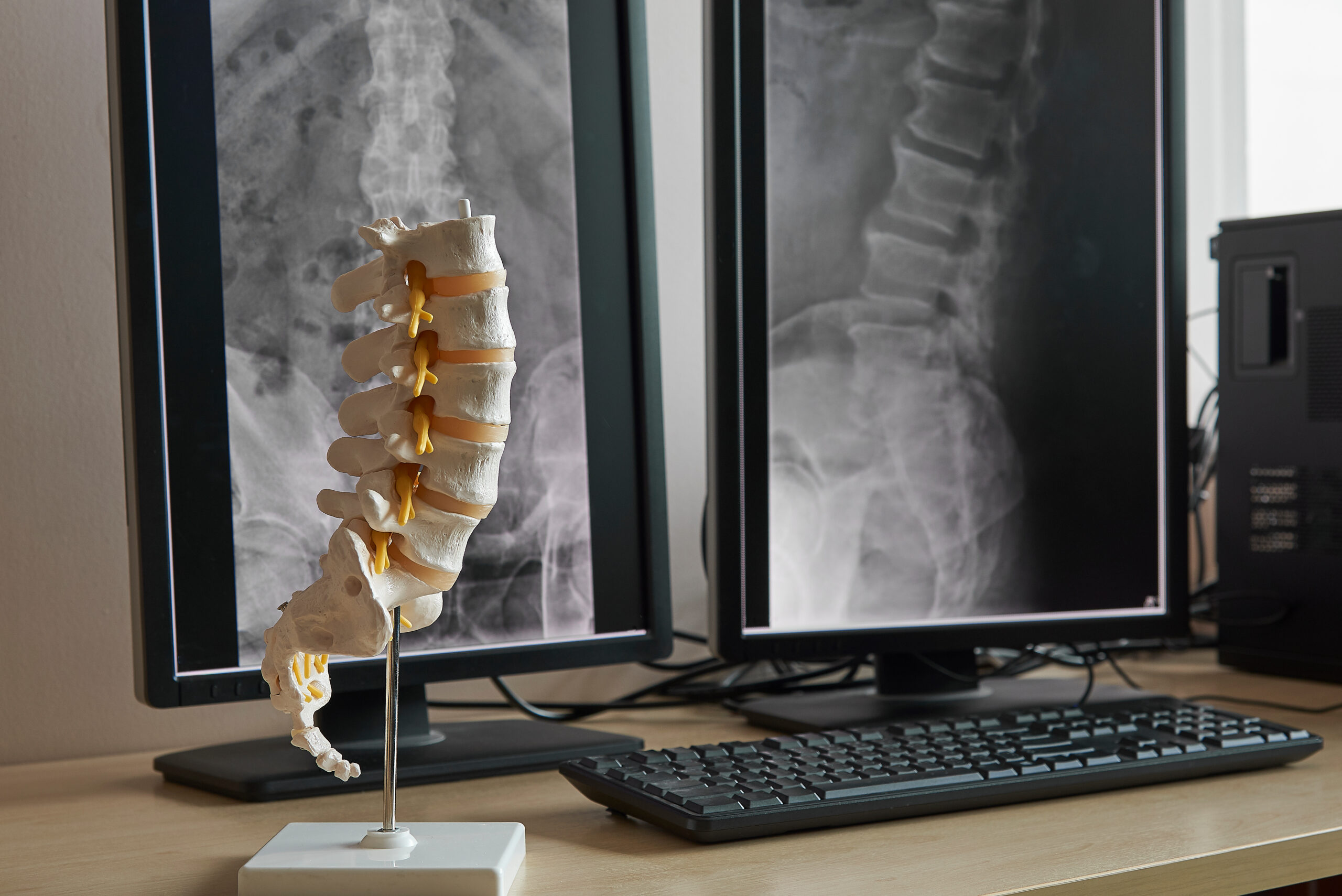 Skeletal Dysplasia – Specialized Orthopedic Management of Rare Bone Growth Disorders
